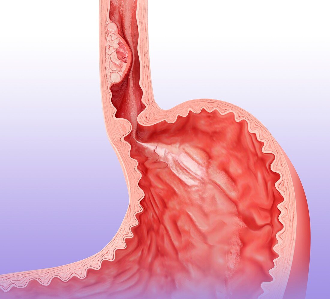 Oesophageal cancer,illustration