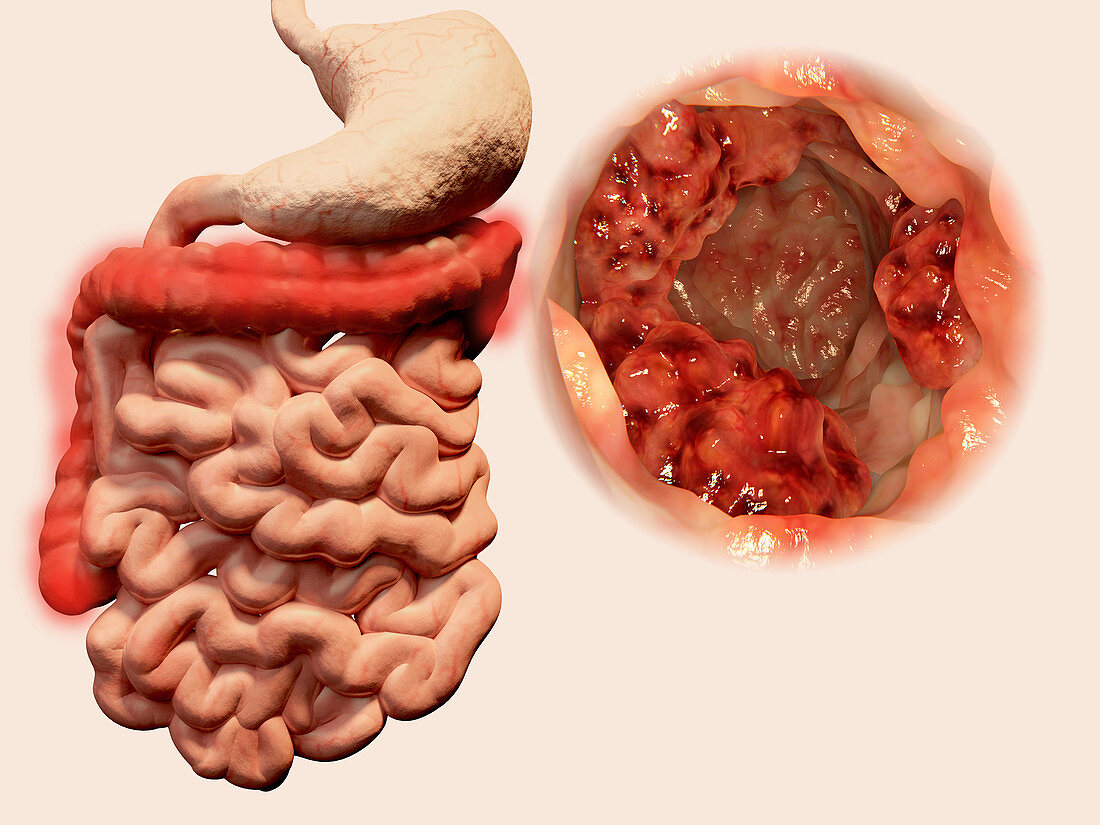 Colon cancer,illustration