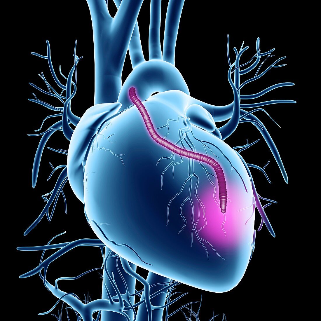 Heart bypass graft,artwork