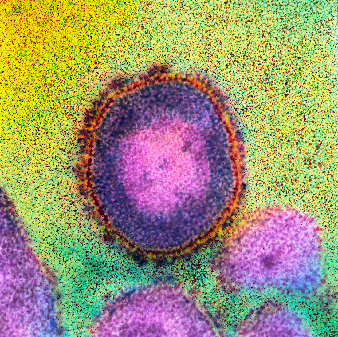 Coloured TEM of an HIV virus