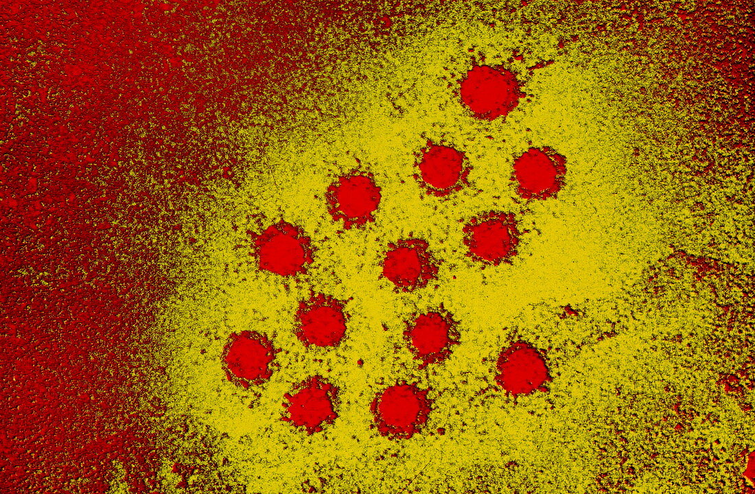 False-col TEM of virions of the Hepatitis A virus