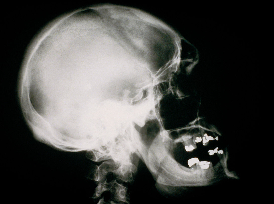 X-ray of human skull showing acromegaly