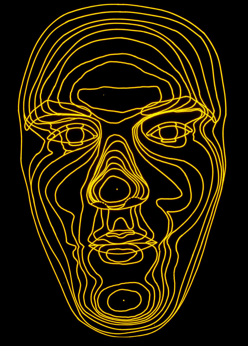 Contour map of face in acromegaly