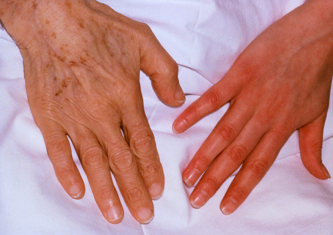 Persons hand with iron deficiency & healthy hand