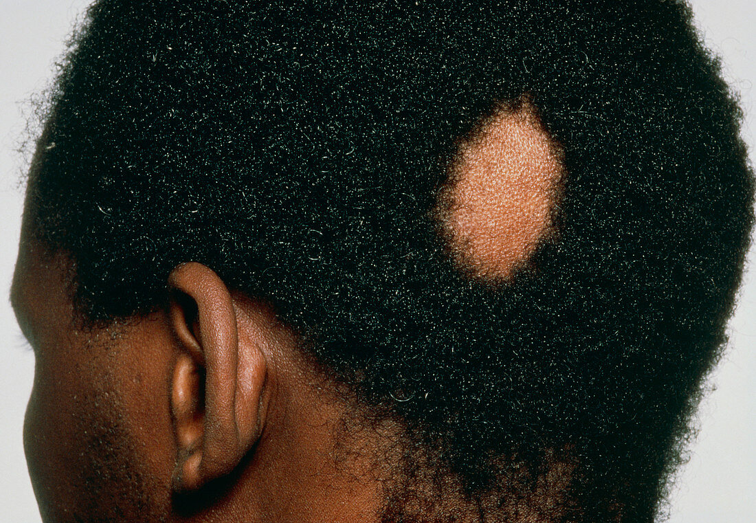 Man suffering from alopecia areata