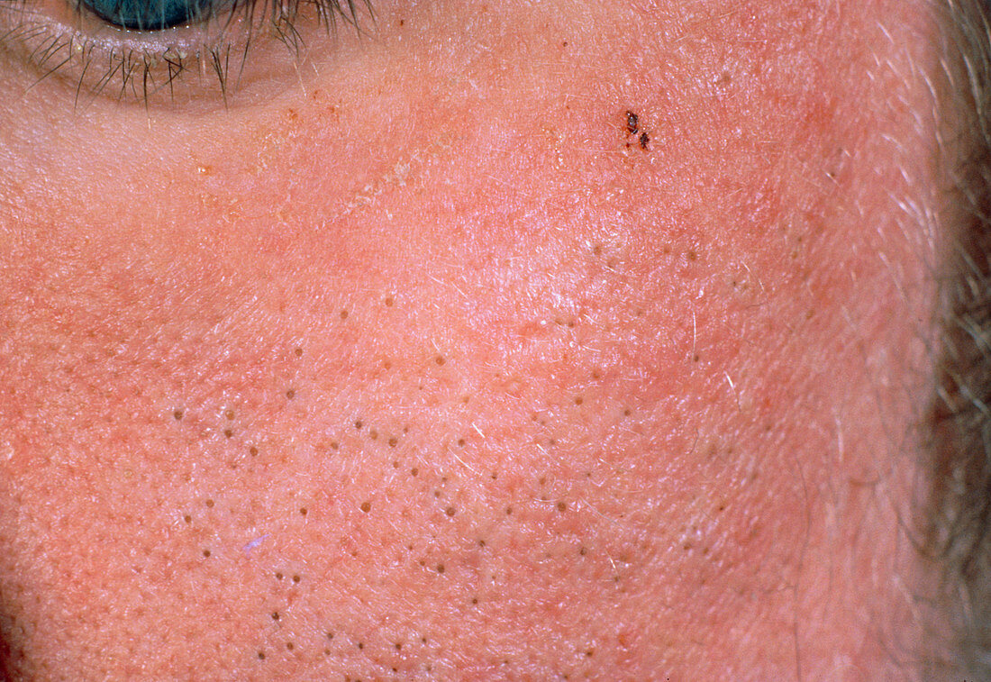Acne vulgaris: blackheads on a man's face
