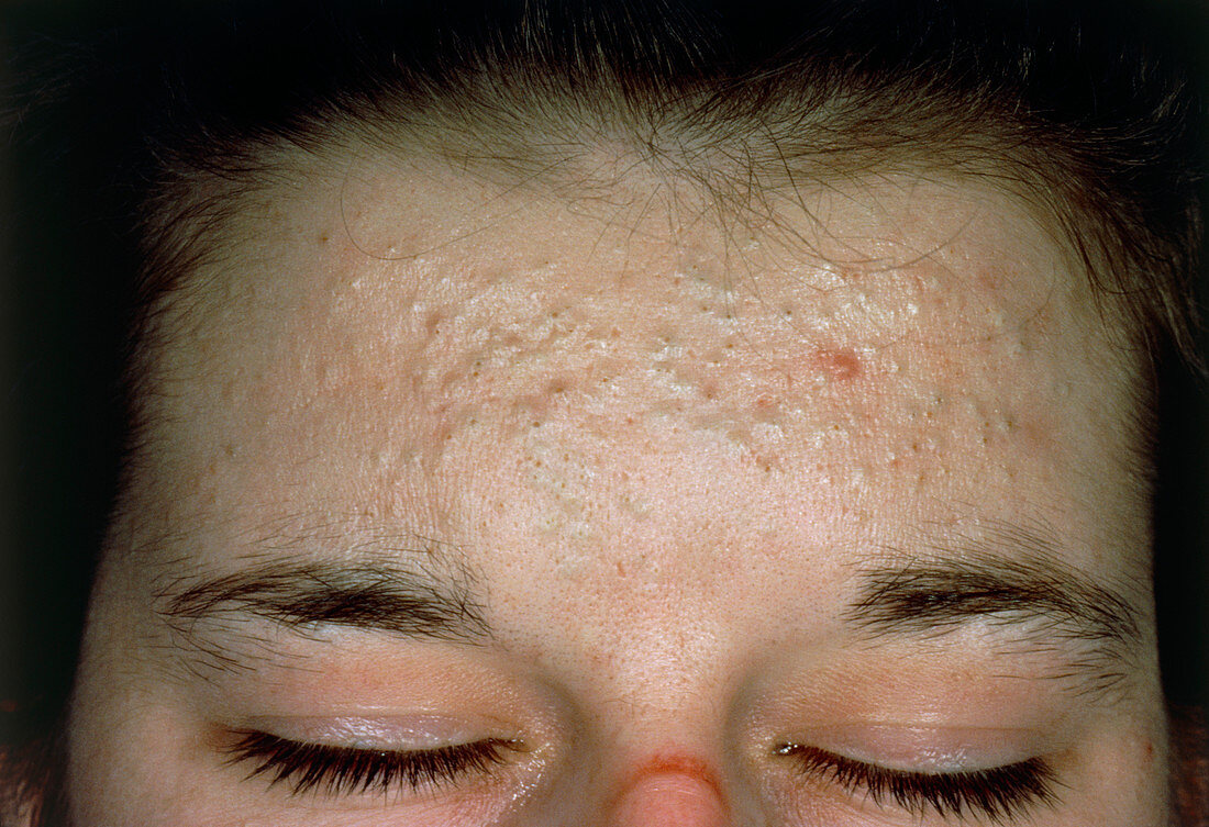 Acne vulgaris: scarring over a woman's forehead