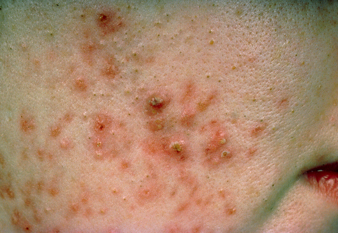 Acne vulgaris: pustules on young woman's face