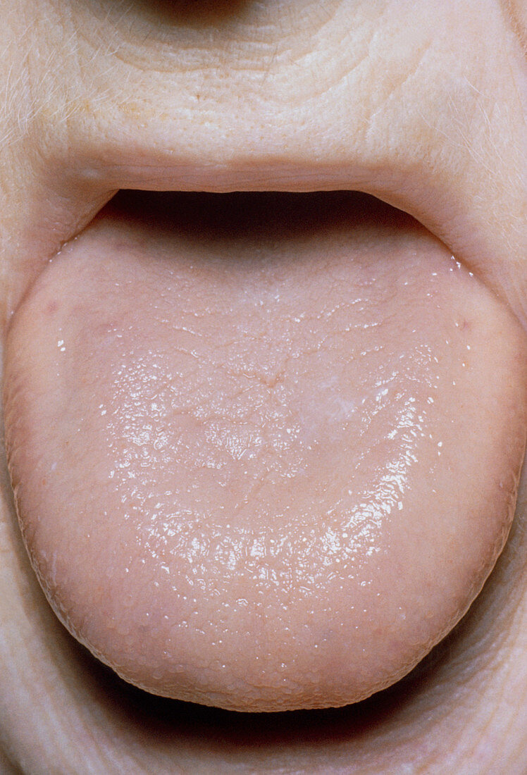 Smooth tongue in pernicious anaemia (Addison's ds)