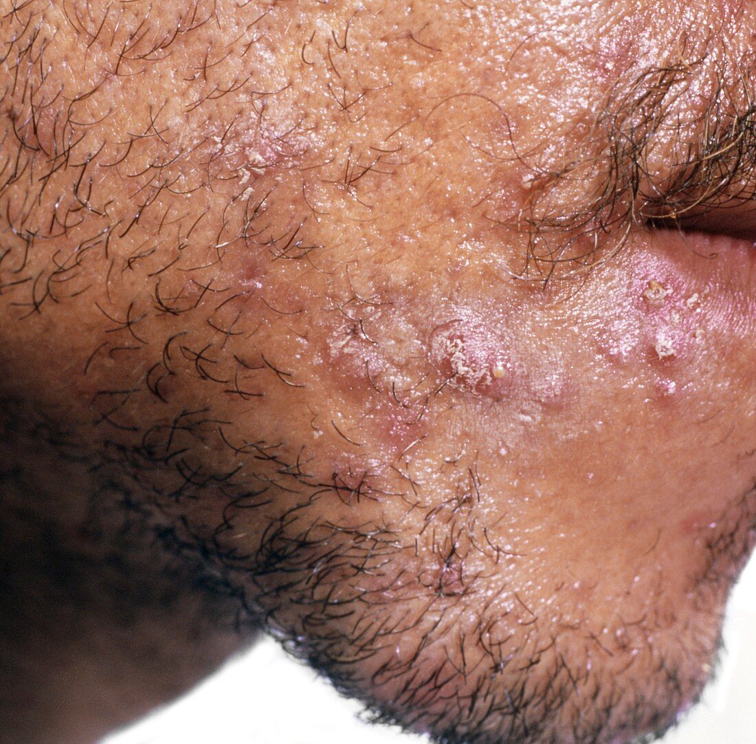 Acne vulgaris: pustules on man's face