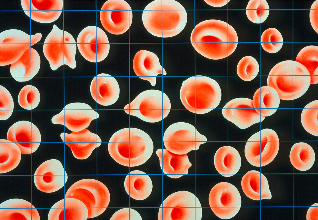 llustration of iron-deficient blood in pregnancy