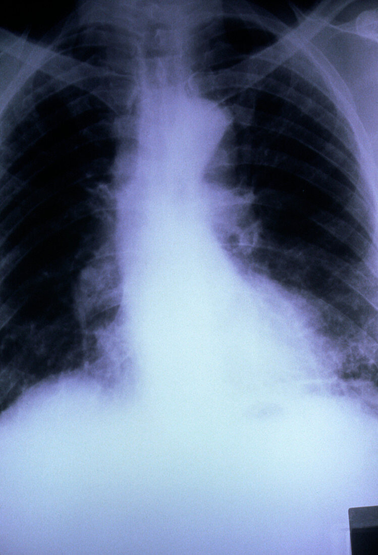 X-ray of lungs affected by fibrosing alveolitis