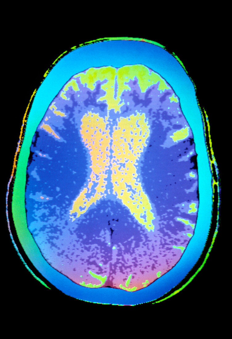 Coloured CT scan of brain with Alzheimer's disease