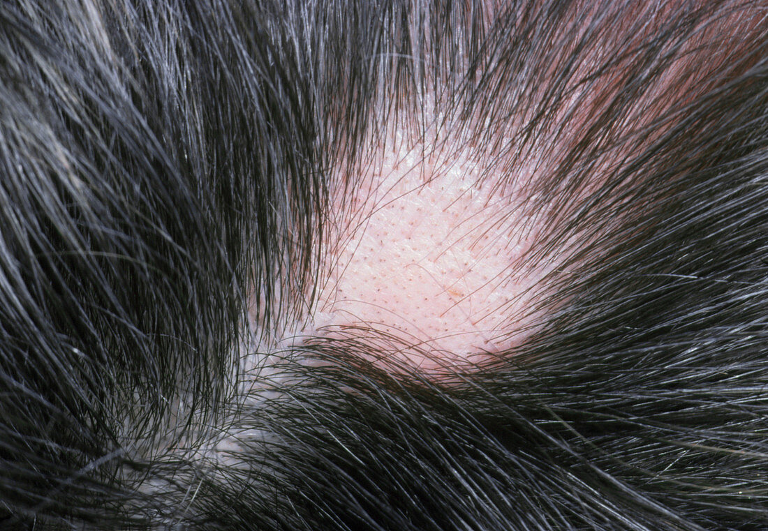 View of a patch of hair loss in alopecia areata