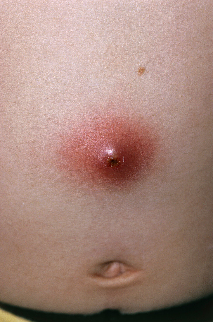 Close-up of an abscess on the abdomen
