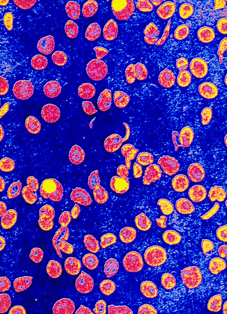 Coloured LM of blood in sickle cell anaemia