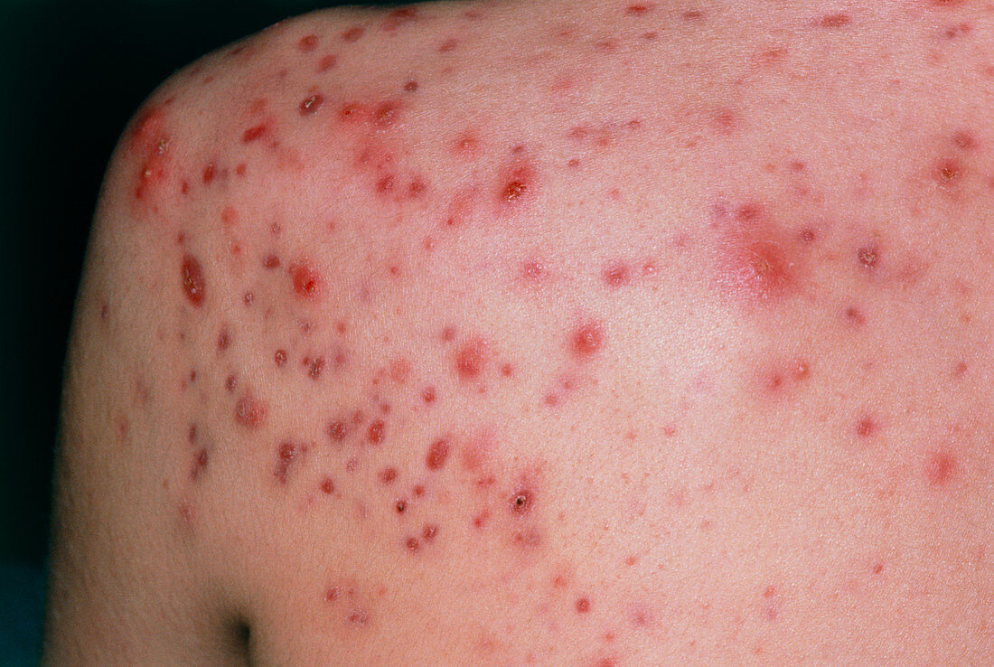 View of severe acne vulgaris on man's shoulder