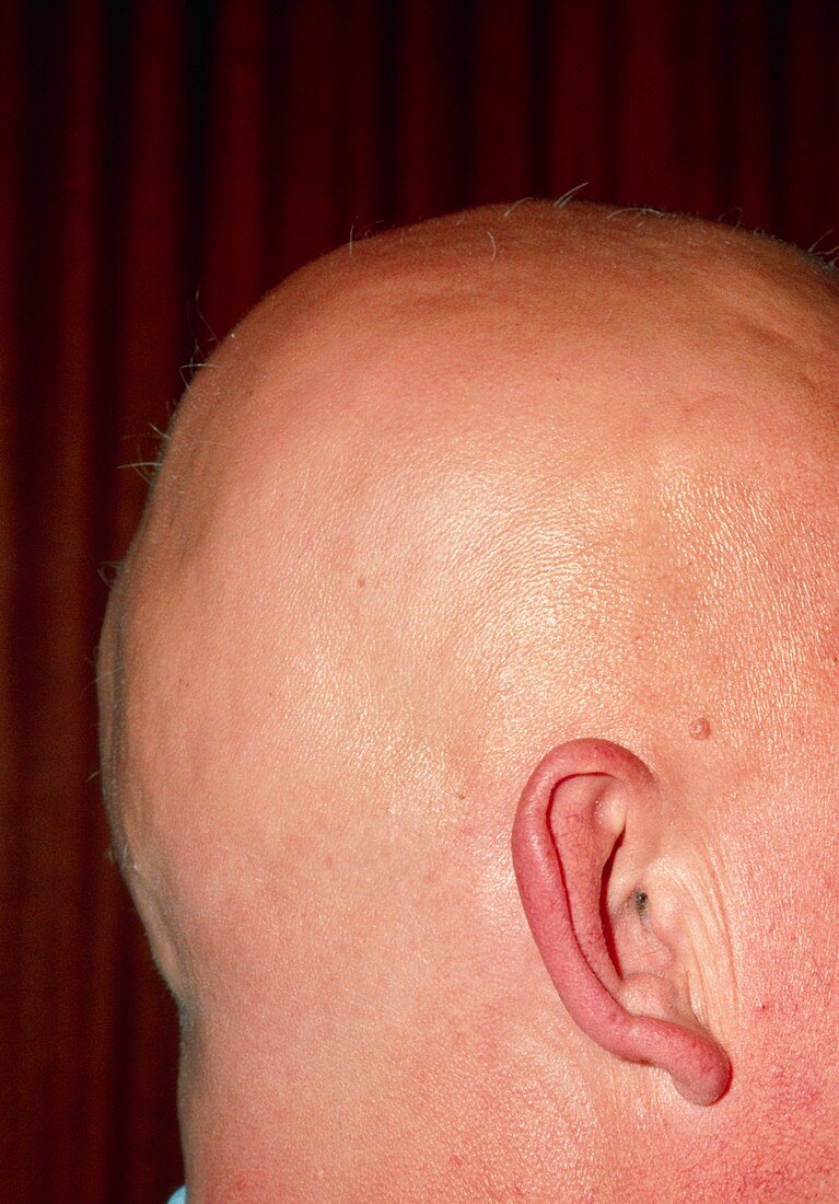 Alopecia areata (hair loss) over the scalp of man