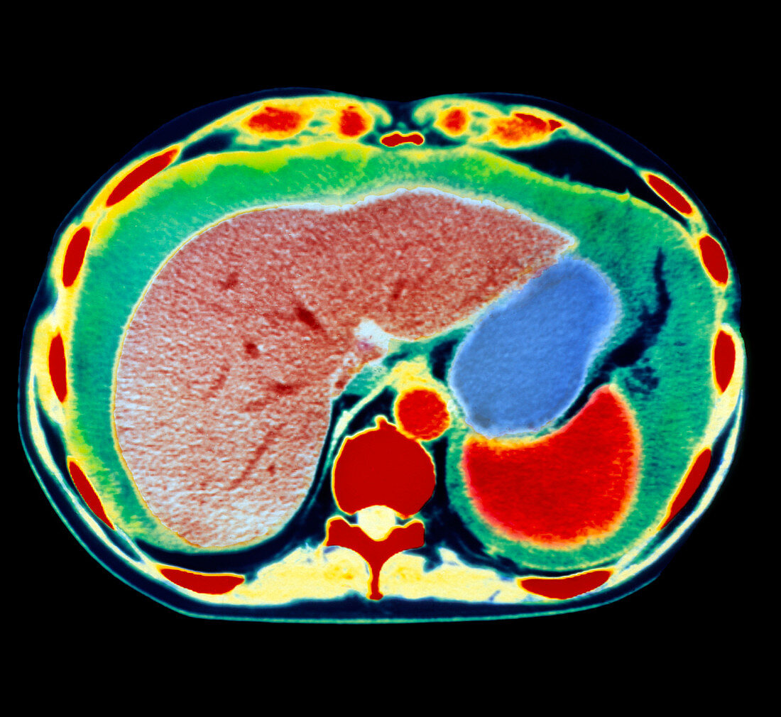 Coloured CT scan showing ascites of the abdomen