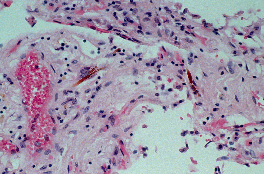 Light micrograph of asbestos fibres in lung tissue