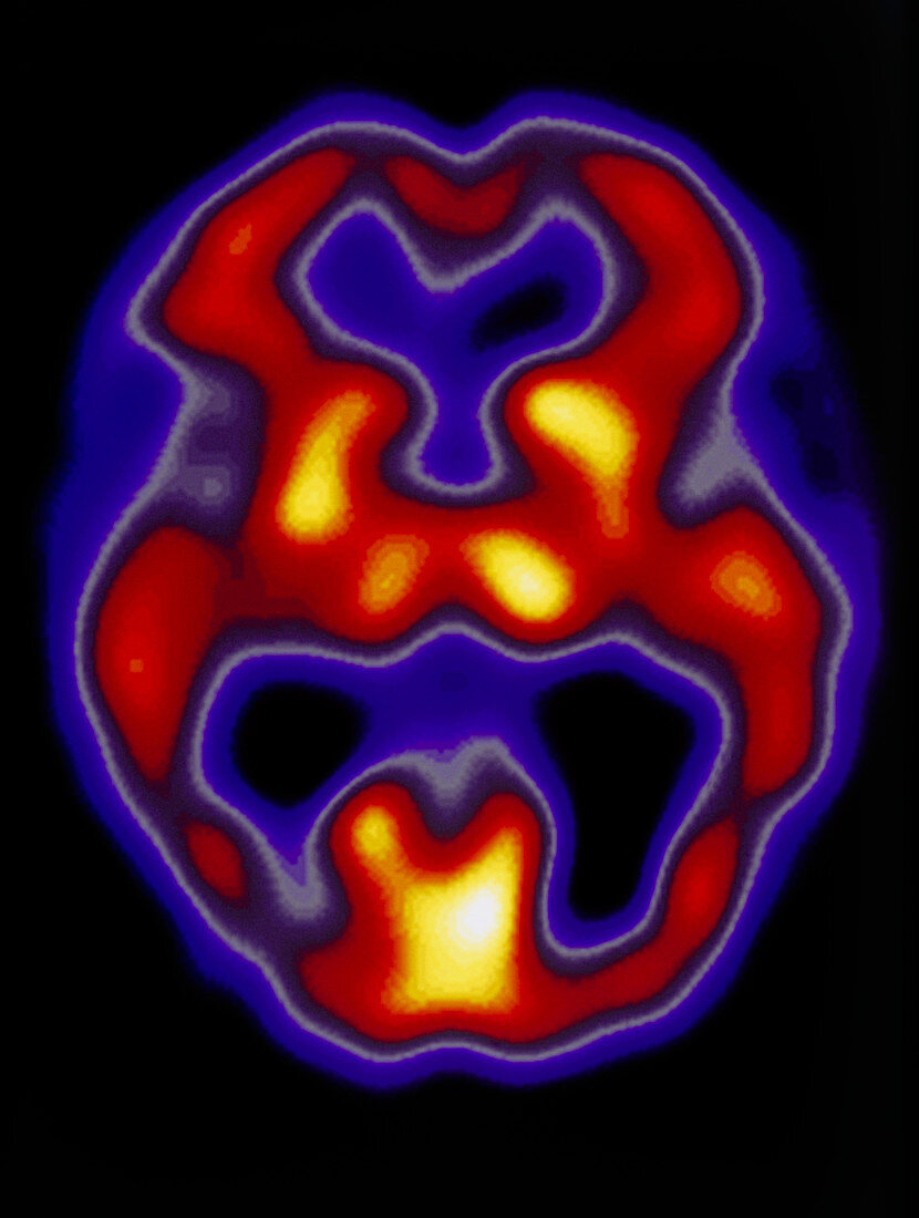 SPECT scan of a brain with Alzheimer's disease