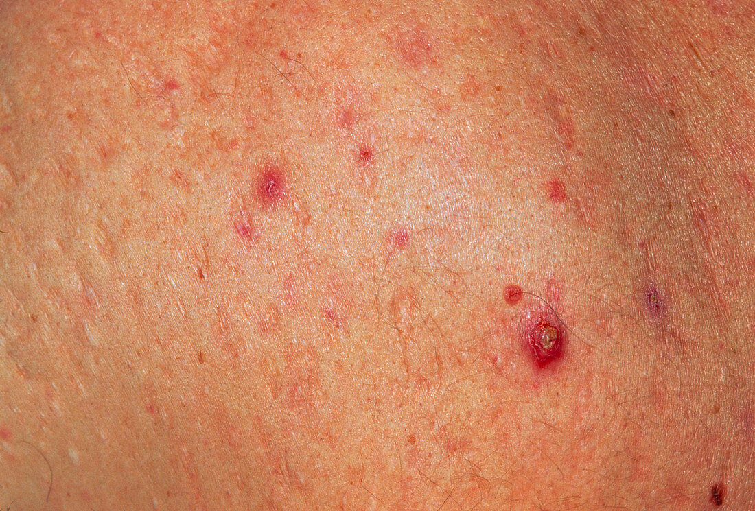 Acne vulgaris scars on back of 30 year old man