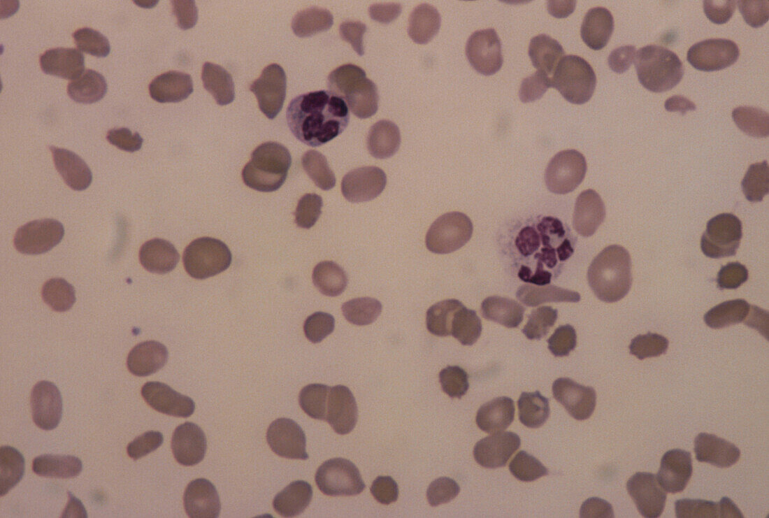 LM of a blood smear in pernicious anaemia