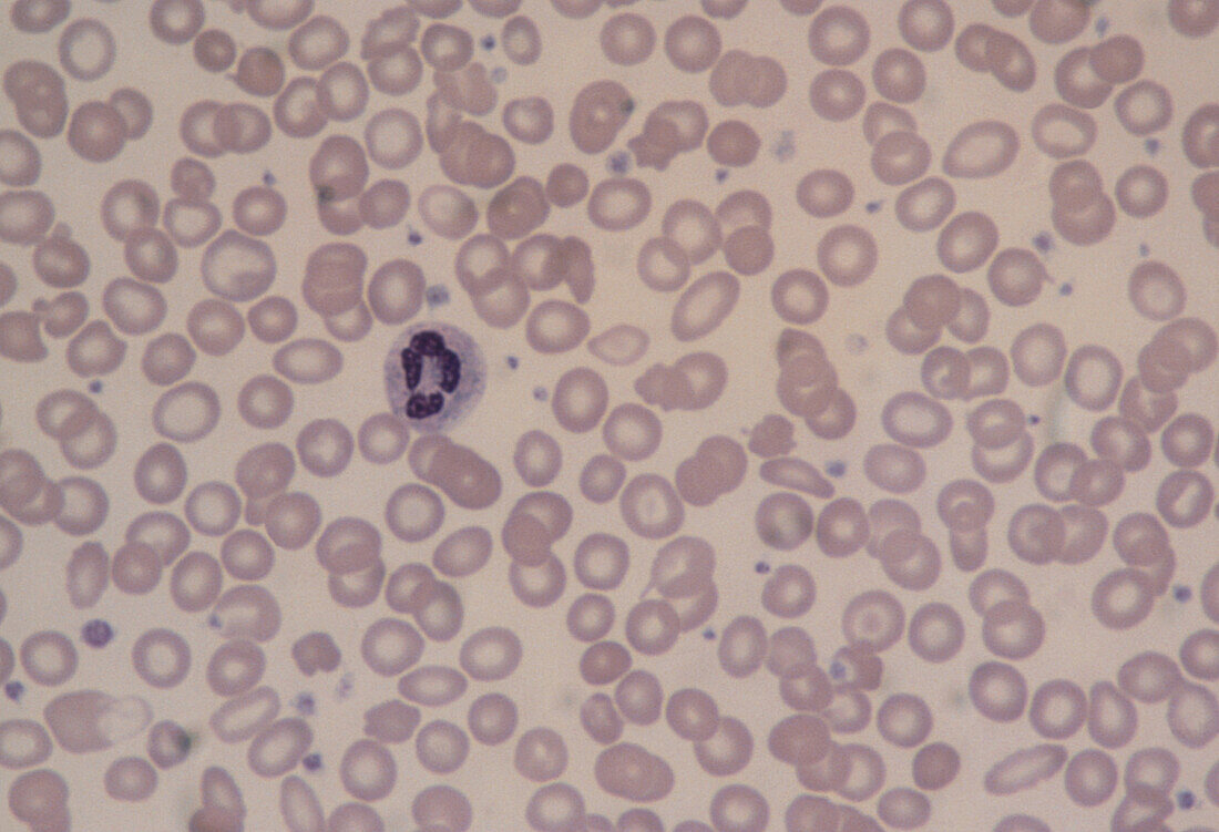 LM of blood with iron-deficiency anaemia