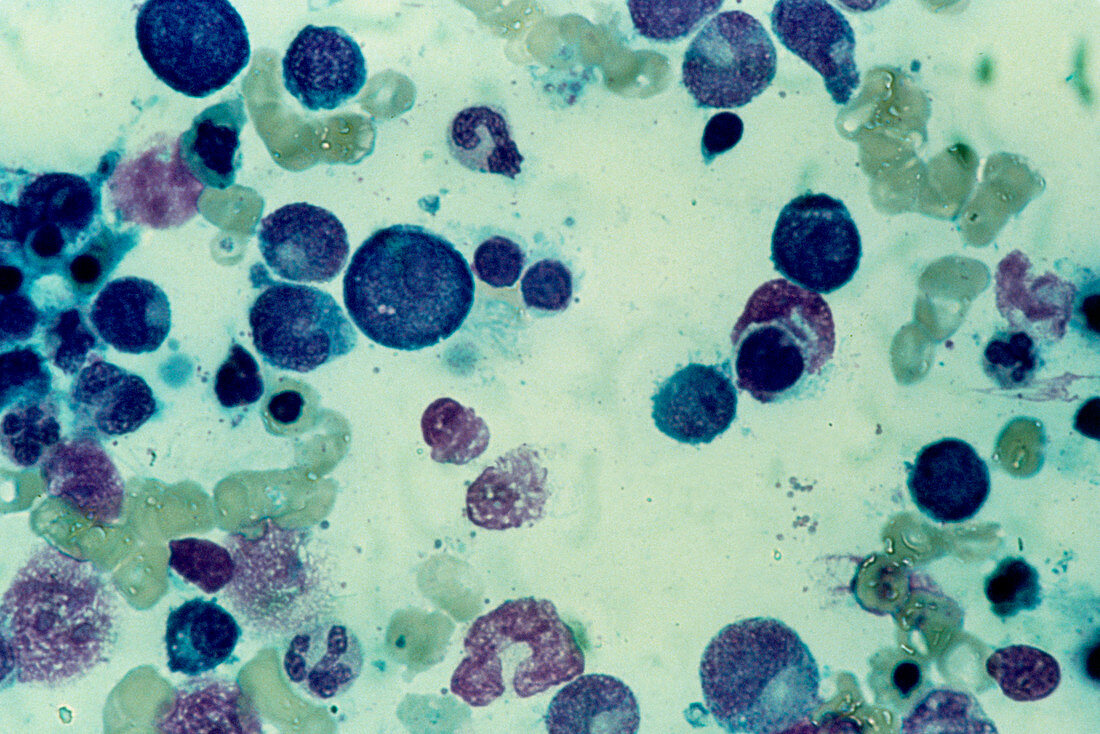 LM of bone marrow in megaloblastic anaemia