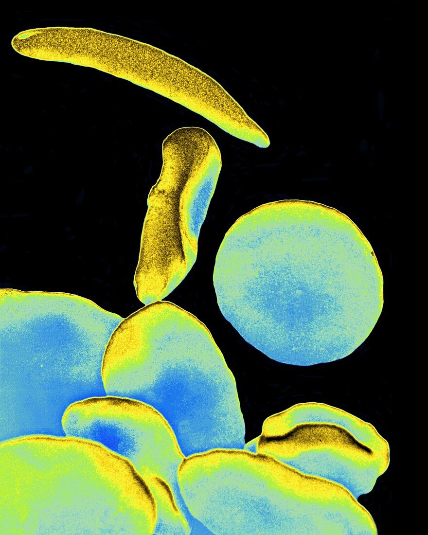 Coloured SEM of blood in sickle cell anaemia