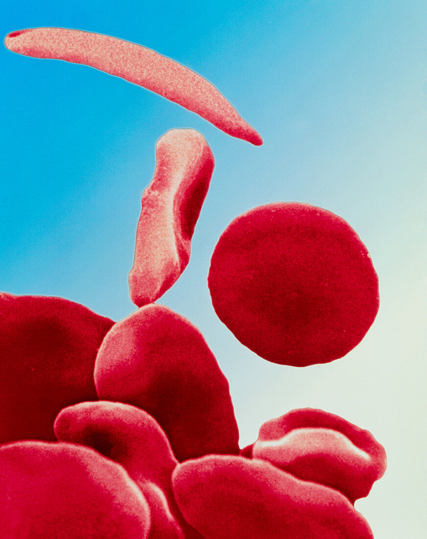 Coloured SEM of blood in sickle cell anaemia