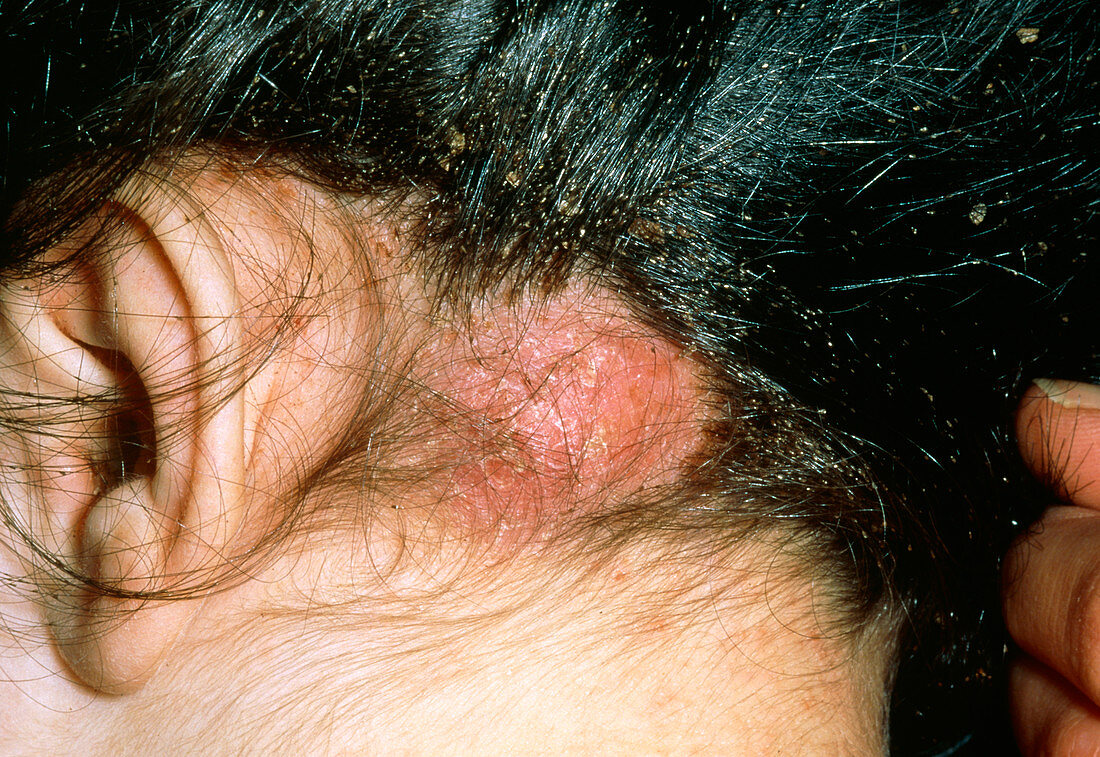 Abscess on scalp of child due to lice irritation
