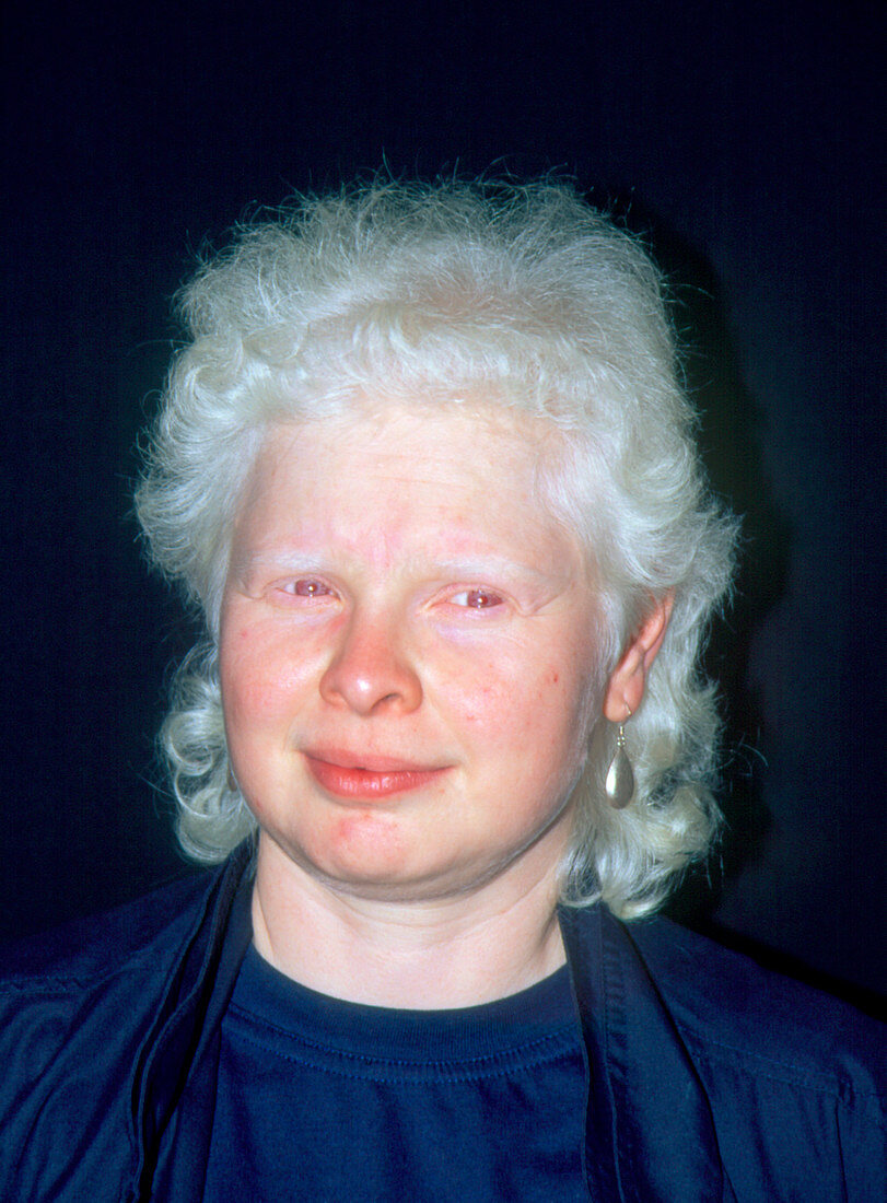 Face of a woman with albinism