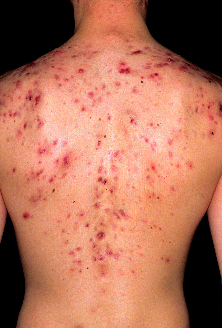 Acne vulgaris on the back of a young man