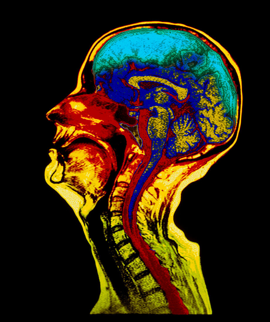 Coloured MRI scan of a brain with cerebral atrophy