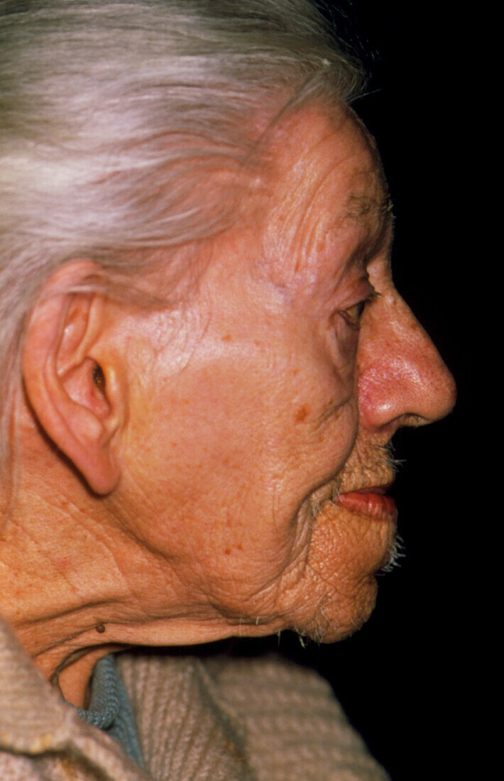 Profile of an elderly woman showing acromegaly
