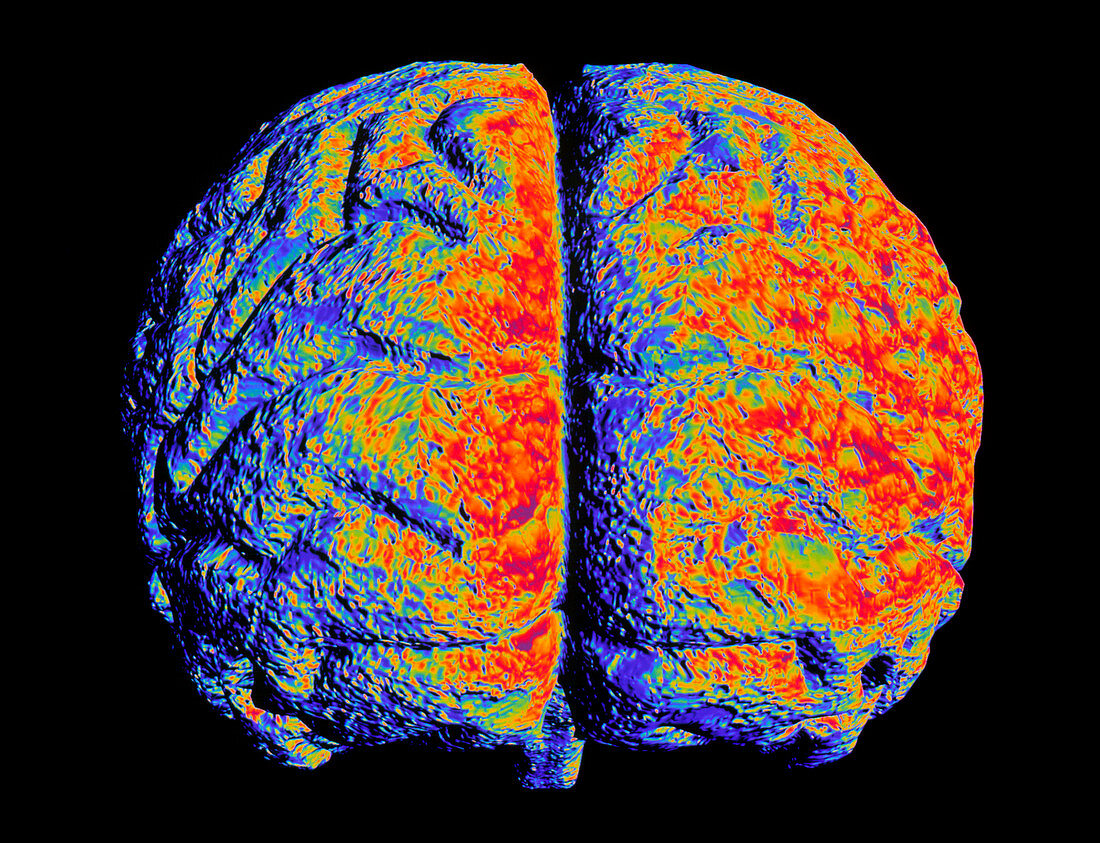Artwork of brain with Alzheimer's disease