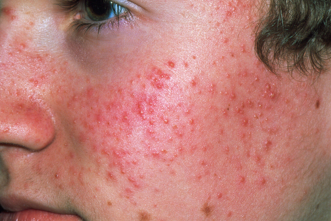 Acne vulgaris on a teenage boy's face