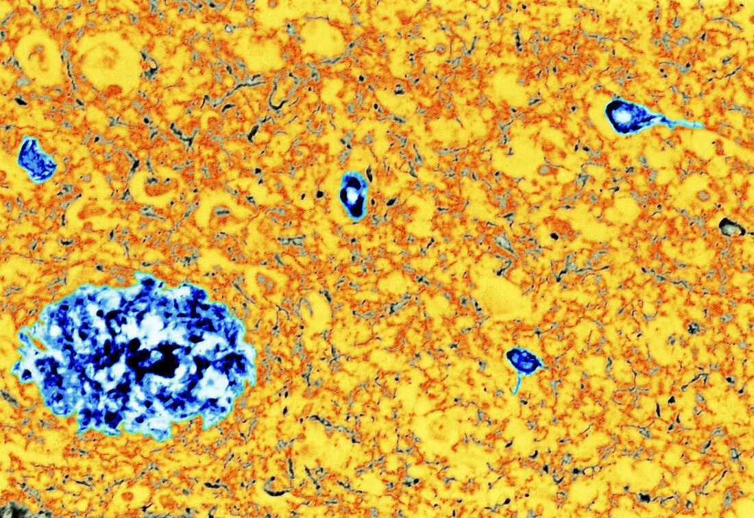 Coloured LM of Alzheimer's disease brain tissue
