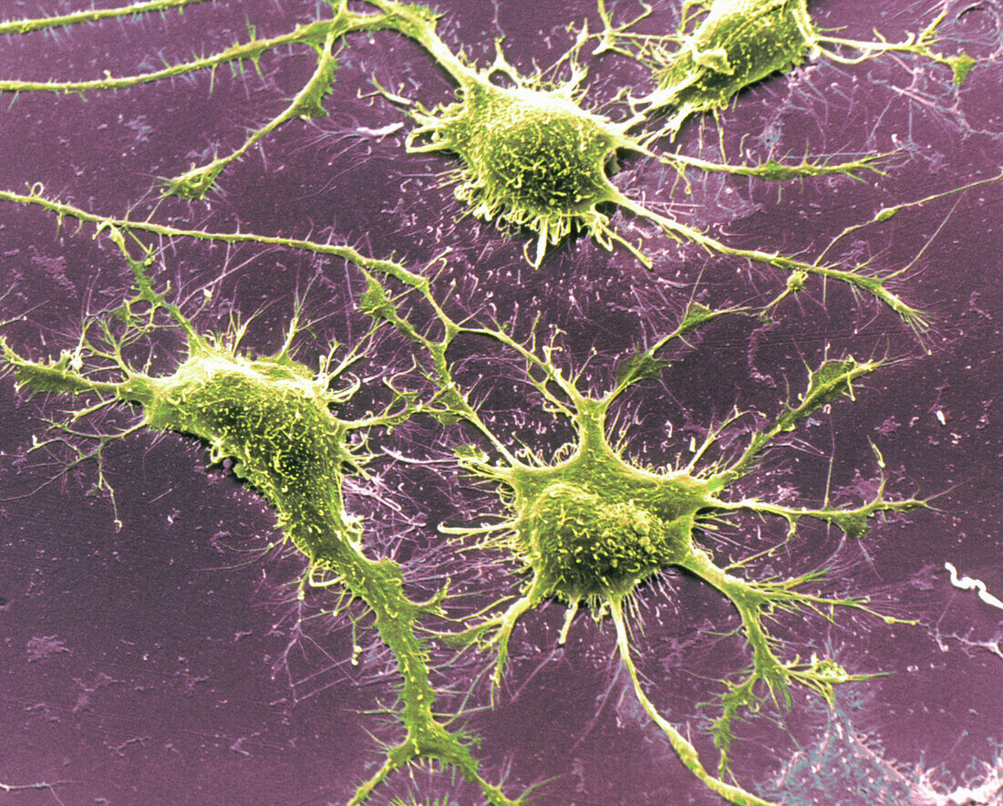 Coloured SEM of Alzheimer's disease culture cells