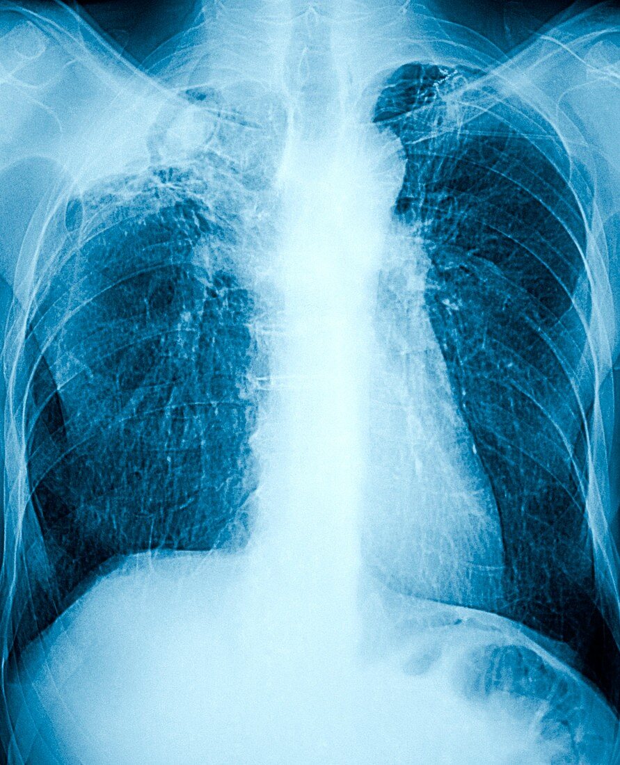 Aspergillosis,X-ray