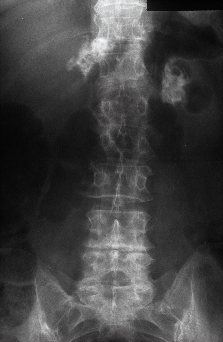 Addison's disease,X-ray