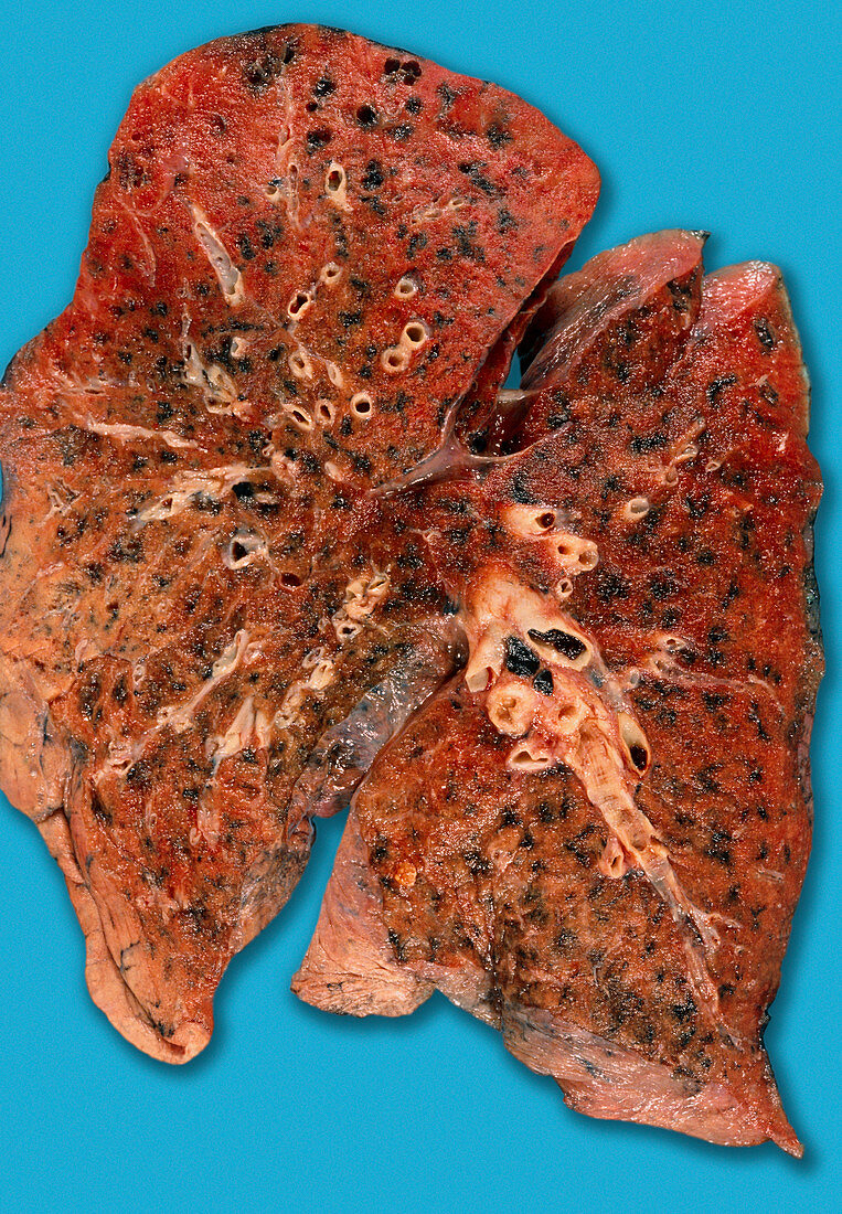 Anthracosis of the lung