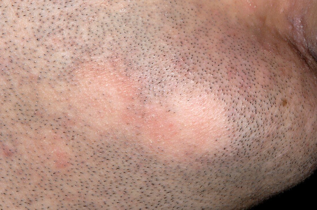 Alopecia areata on face