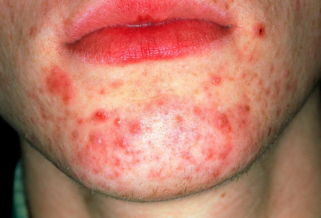 Acne on chin