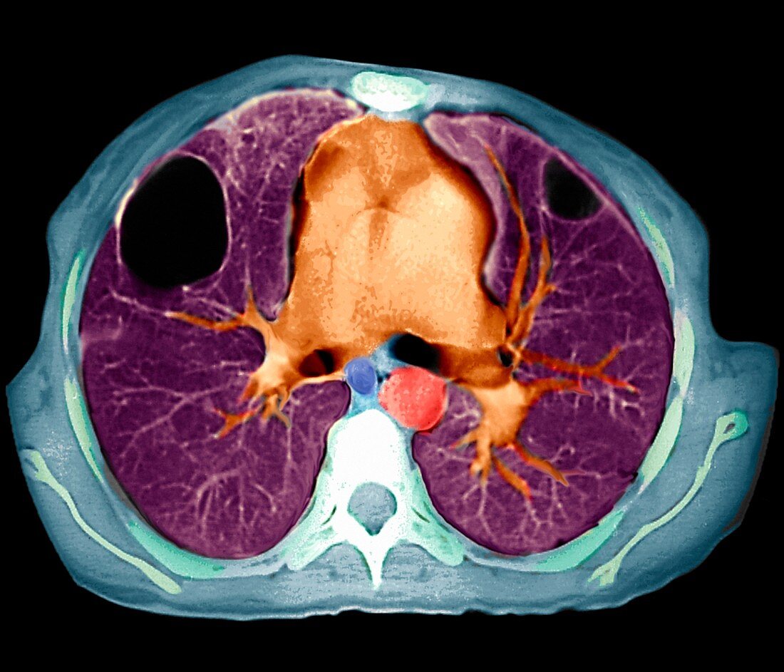 Lung abscesses,CT scan