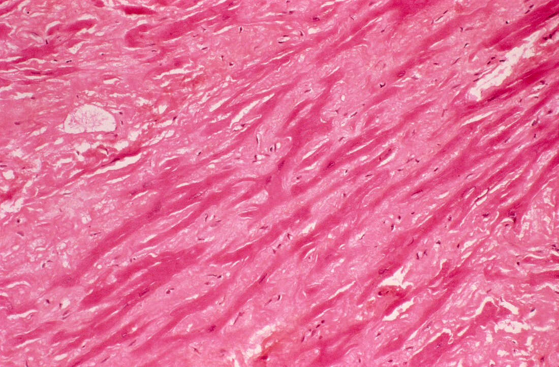 Amyloidosis,light micrograph