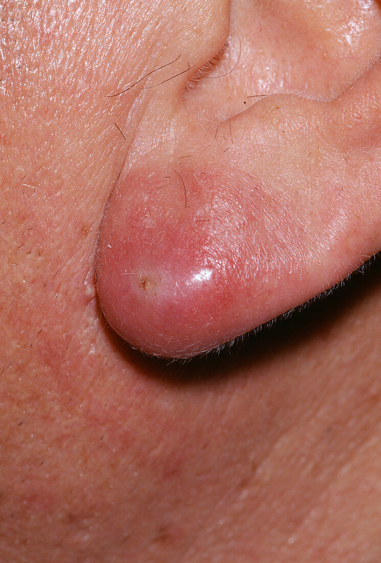 Ear abscess