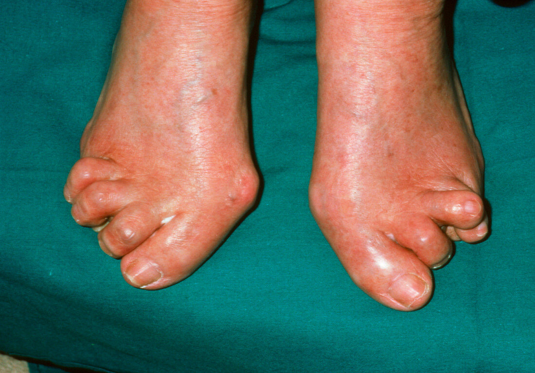 Feet severely affected by rheumatoid arthritis