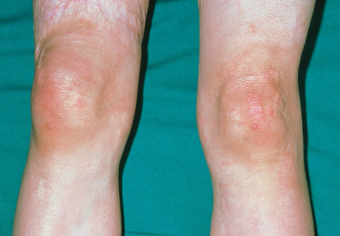 Close up: knees compared for acute monoarthritis